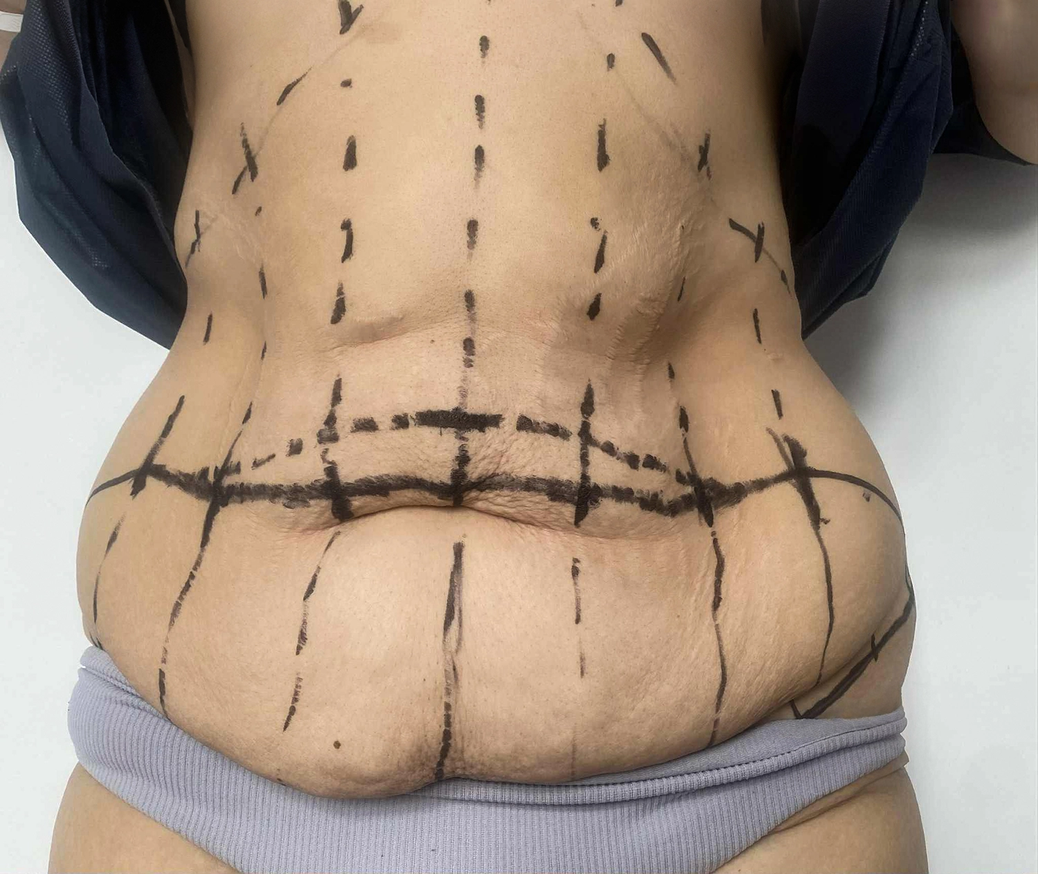 Abdominoplastyka