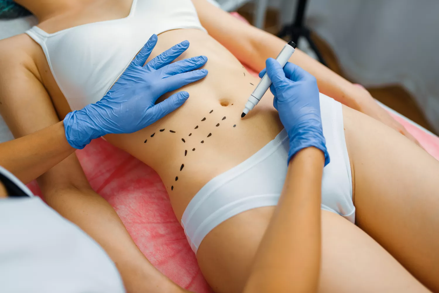 Chirurgiczna plastyka brzucha Gdańsk - Alfa Clinic Centrum Medyczne (Chirurgia)