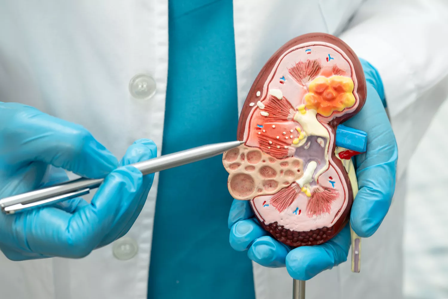 Diagnostyka i leczenie kamicy nerkowej Gdańsk - Alfa Clinic Centrum Medyczne (Urologia)