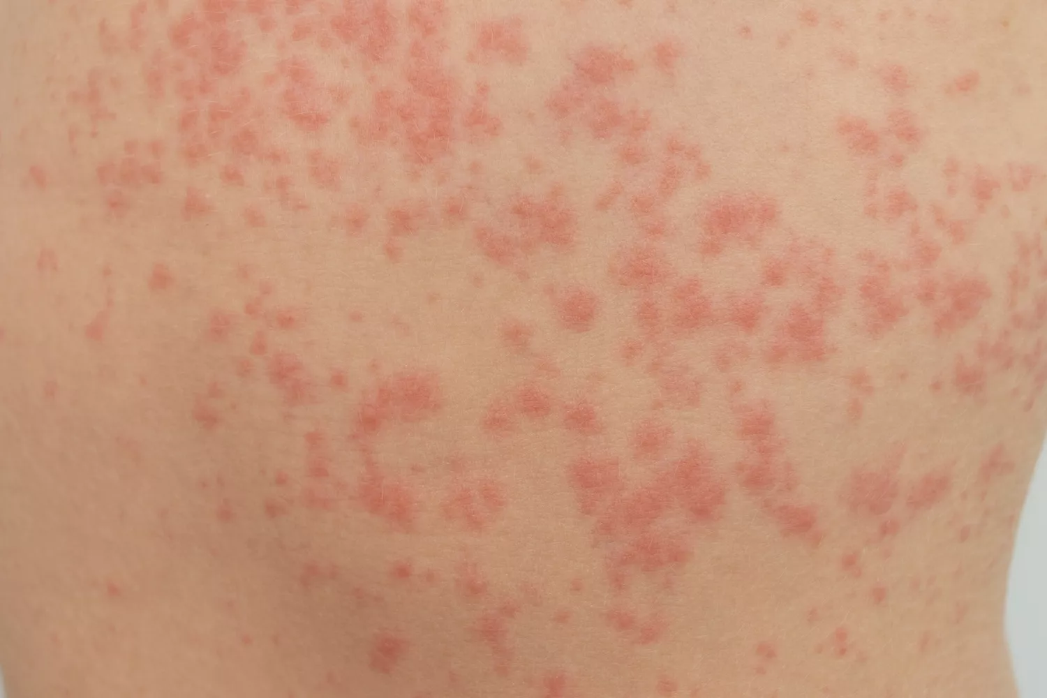 Diagnostyka odry Gdańsk - Alfa Clinic Centrum Medyczne (Pediatria)