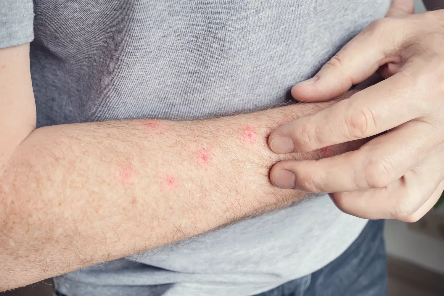 Leczenie alergicznych zapaleń skóry Gdańsk - Alfa Clinic Centrum Medyczne (Alergologia)